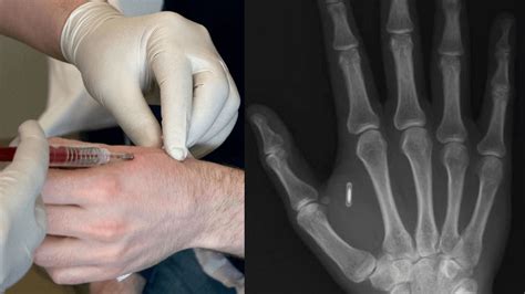 couple in the netherlands get rfid chip|rfid chip implants.